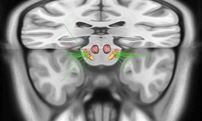 Connectivity Patterns of Subthalamic Stimulation Influence Pain Outcomes in Parkinson's Disease